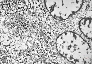 F,73y. | mixed mucinous and endocrine carcinoma F,73y. | mixed mucinous and endocrine carcinoma